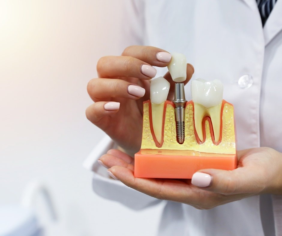 moi-nho-rang-co-trong-implant-duoc-khong1-1747645361.png