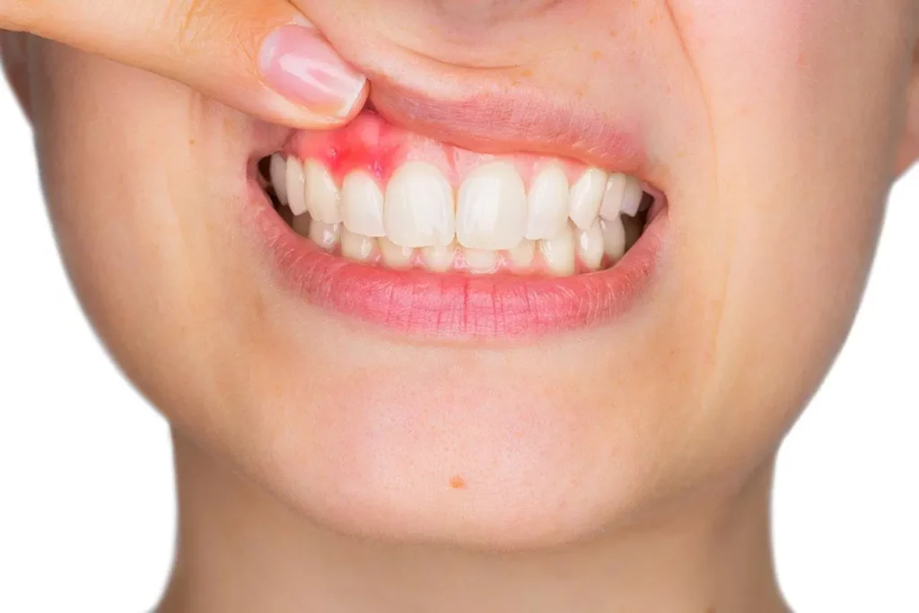 moi-nho-rang-co-trong-implant-duoc-khong3-1747645361.png