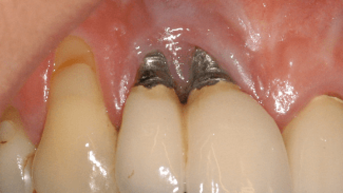 trong-rang-implant-co-gay-hoi-mieng-khong3-1747645884.png