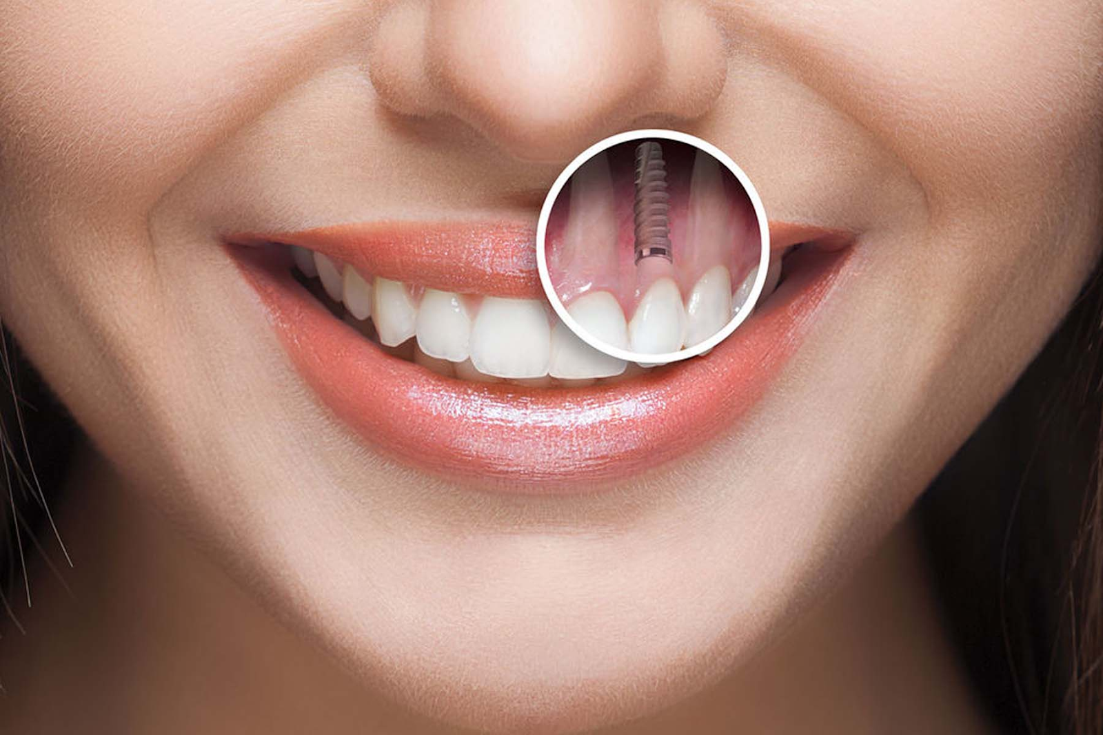 rang-implant-co-bi-hong-khong1-1753169625.png
