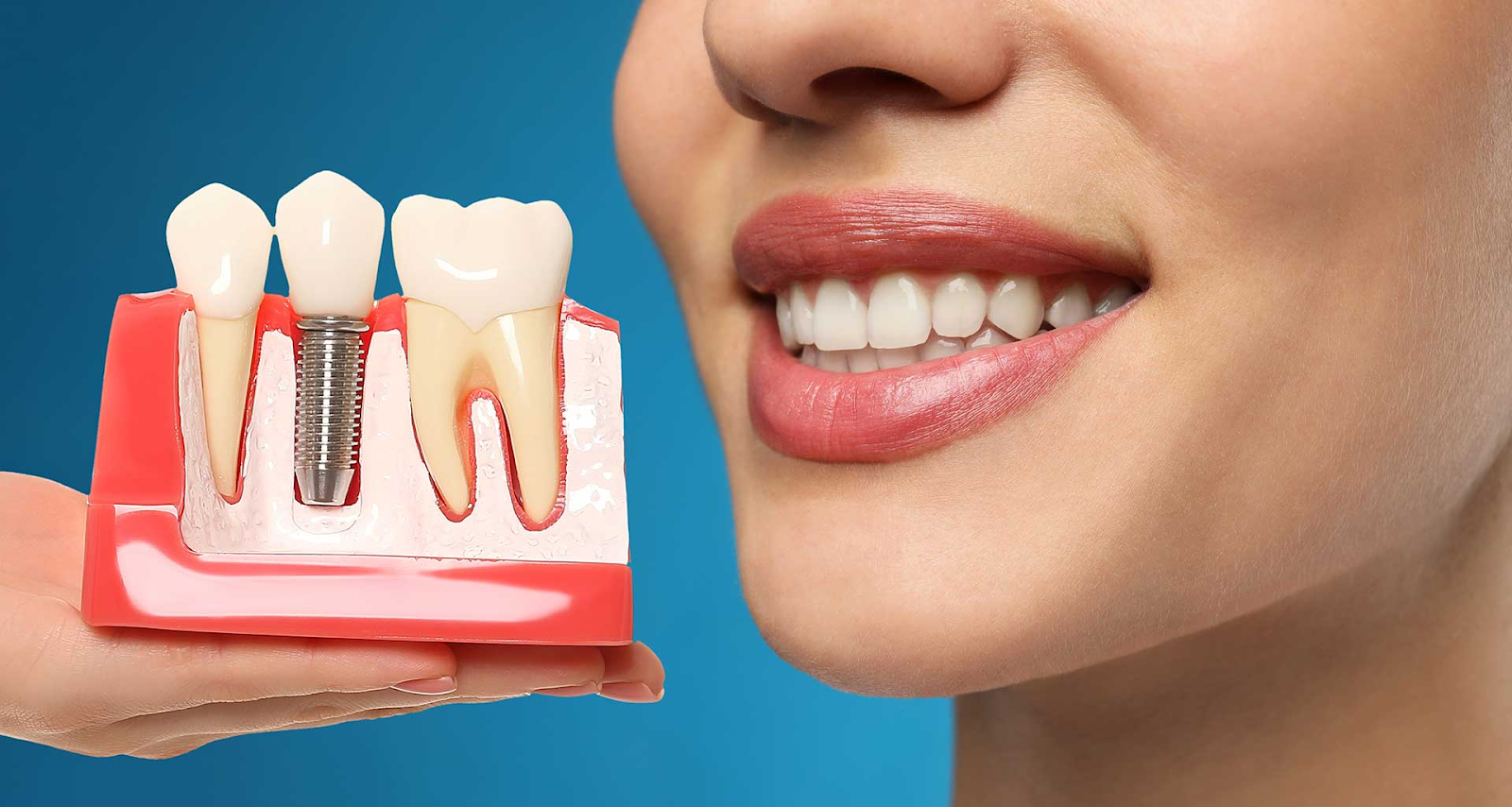 rang-implant-co-bi-hong-khong2-1753169625.png