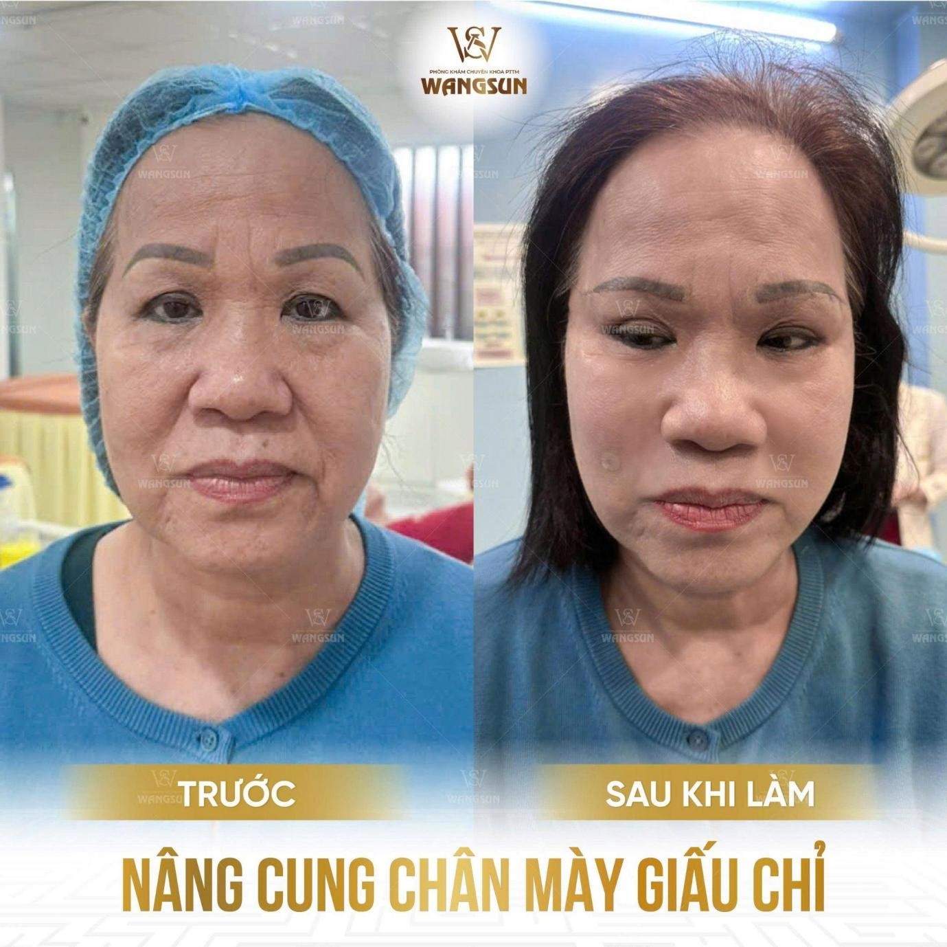 nang-cung-chan-may-giau-chi-truoc-va-sau-khi-lam-1755610473.jpg