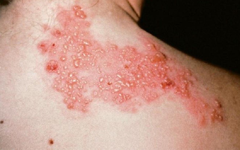 Chủ động tiêm vắc xin phòng zona thần kinh cho người cao tuổi