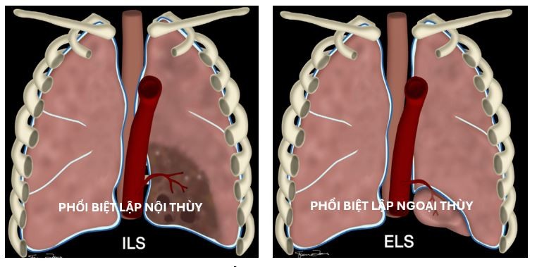 Ứng dụng robot trong điều trị phổi biệt lập