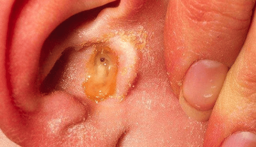 Viêm tai giữa dễ tái phát, có thể gây suy giảm thính lực nếu chủ quan
