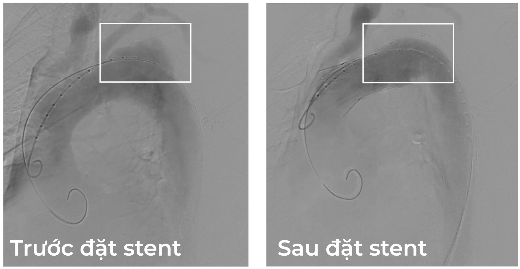 cu-ong-78-tuoi-thoat-cua-tu-sau-khi-vo-dong-mach-chu-nguc-1782443366.png