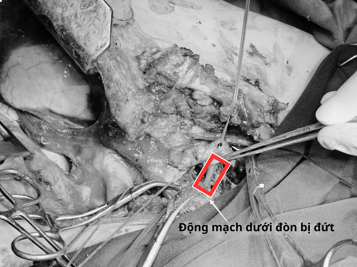 cuu-nam-thanh-nien-dut-dong-mach-duoi-don-mat-gan-4-lit-mau-1-1787289738.png