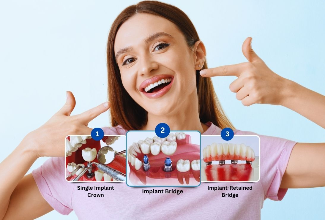 trong-rang-implant-giup-tiet-kiem-chi-phi-ve-lau-dai-1753182825.png