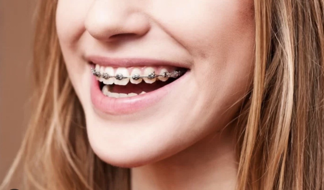 Hành trình niềng răng lấy lại nụ cười rạng rỡ: Từ tự ti thành tự tin