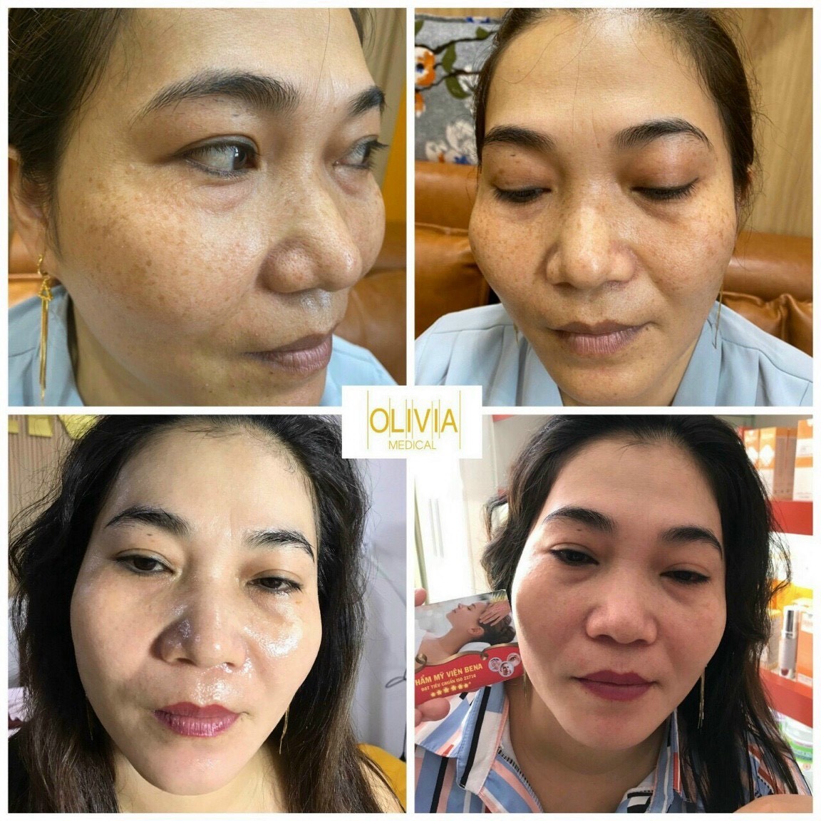 Thẩm mỹ viện trị nám uy tín tại Gia Lai