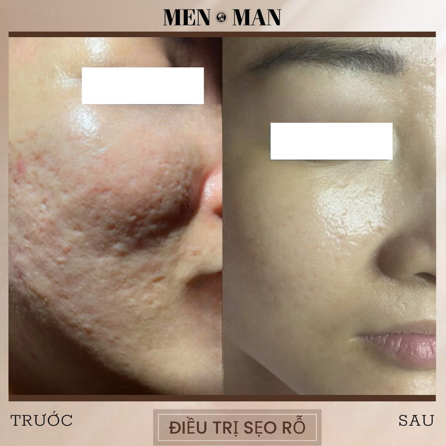 Hành trình tìm lại sự tự tin sau 4 năm sống chung cùng sẹo rỗ do mụn