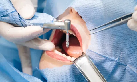 Top 4 băn khoăn thường gặp trước khi trồng răng Implant