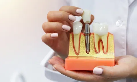 Mới nhổ răng có trồng Implant được không? Có cần đợi lành thương hay không?