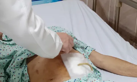 Cụ ông 69 tuổi bị bỏng thực quản vì uống nhầm nước tro tàu