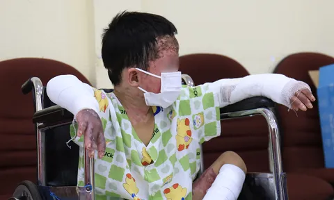 Bé trai bỏng 65% sau vụ nghi phóng hỏa ở Gia Lai hồi phục ngoạn mục