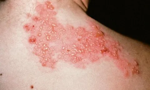 Chủ động tiêm vắc xin phòng zona thần kinh cho người cao tuổi