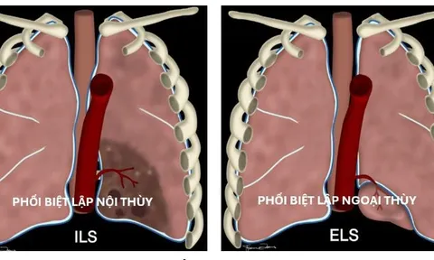 Ứng dụng robot trong điều trị phổi biệt lập