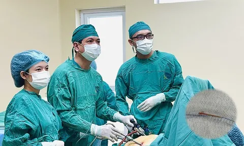 Đau bụng nhiều ngày, phát hiện xương cá 3 cm đâm xuyên ruột non