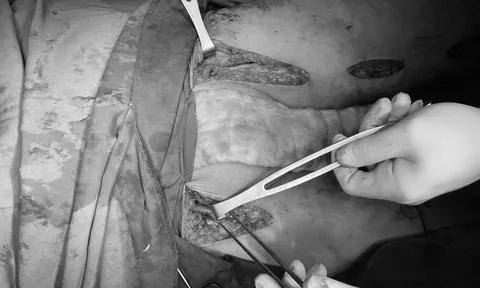 Nguy cơ đoạn chi vì tắc mạch, người đàn ông 58 tuổi được cứu nhờ mổ bắc cầu