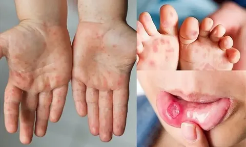 Ngành y tế phía Nam tăng cường ứng phó tay chân miệng