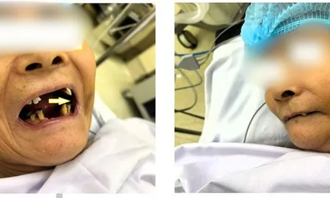 Loét miệng kéo dài, cụ bà phát hiện ung thư vùng má