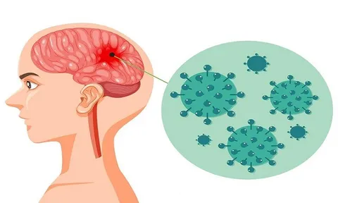 Bệnh não mô cầu: Diễn tiến nhanh, dễ tử vong nếu không phát hiện sớm