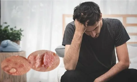 Sùi mào gà ngày càng phức tạp: Không chỉ trẻ hóa, mà còn dễ bị bỏ sót vì chủ quan