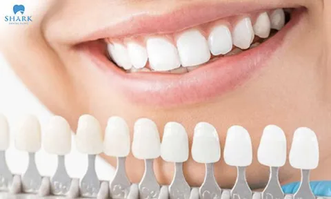Bọc răng sứ Cercon HT có ưu điểm gì? Nên thực hiện ở đâu?