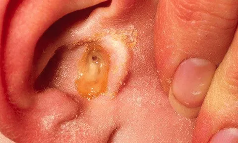 Viêm tai giữa dễ tái phát, có thể gây suy giảm thính lực nếu chủ quan