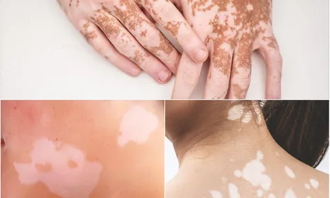 Bạch biến không lây nhiễm, điều người bệnh cần là sự thấu hiểu