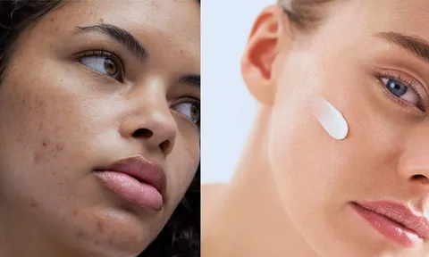Da đỏ, bong tróc sau peel: Khi nào là bình thường?