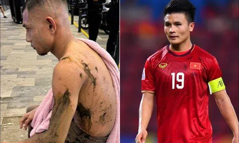 Trước thềm đấu ĐT Việt Nam, 'Ronaldo Malaysia' tái xuất với diện mạo khó tin sau khi bị tạt axit