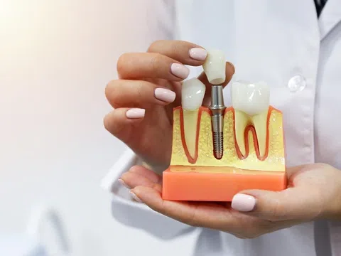 Mới nhổ răng có trồng Implant được không? Có cần đợi lành thương hay không?