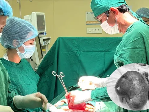 Bóc tách thành công khối u xơ tử cung lớn như thai 20 tuần