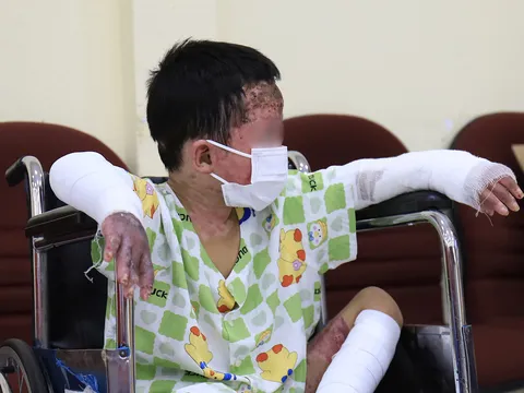 Bé trai bỏng 65% sau vụ nghi phóng hỏa ở Gia Lai hồi phục ngoạn mục