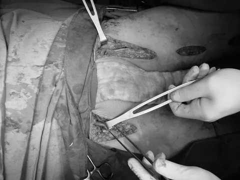 Nguy cơ đoạn chi vì tắc mạch, người đàn ông 58 tuổi được cứu nhờ mổ bắc cầu