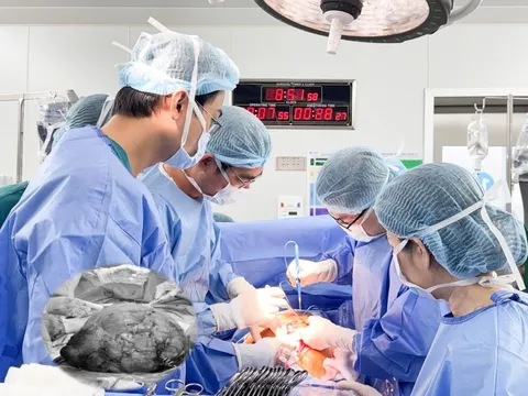 Hiếm gặp: U xơ tử cung gần 12 kg ở phụ nữ 25 tuổi