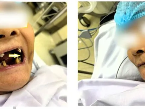 Loét miệng kéo dài, cụ bà phát hiện ung thư vùng má