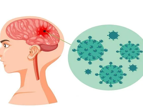 Bệnh não mô cầu: Diễn tiến nhanh, dễ tử vong nếu không phát hiện sớm