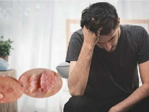 Sùi mào gà ngày càng phức tạp: Không chỉ trẻ hóa, mà còn dễ bị bỏ sót vì chủ quan