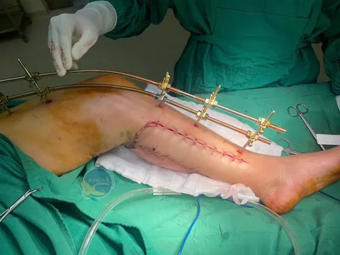 Ngã xe do chó băng ngang, người phụ nữ được cứu chi trong ‘giờ vàng’