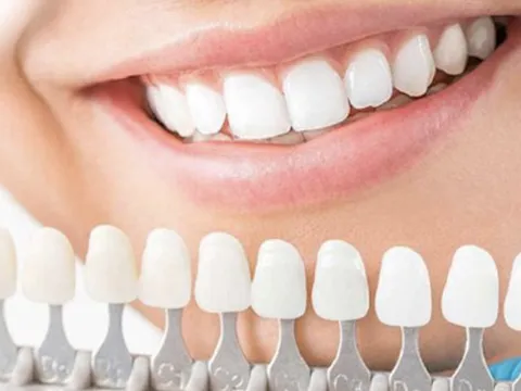 Bọc răng sứ Cercon HT có ưu điểm gì? Nên thực hiện ở đâu?