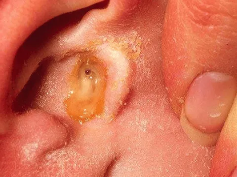 Viêm tai giữa dễ tái phát, có thể gây suy giảm thính lực nếu chủ quan