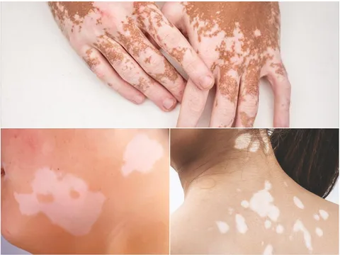 Bạch biến không lây nhiễm, điều người bệnh cần là sự thấu hiểu