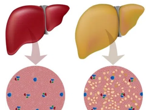 4 bài thuốc trị gan nhiễm mỡ hiệu quả