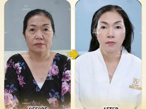 “Tam giác vàng” giúp “trẻ lại cả thập kỷ” - Khám phá 3 công nghệ thẩm mỹ được yêu thích nhất tại WangSun