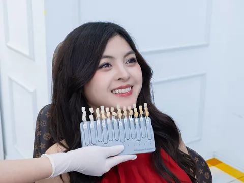 Vì sao có người thẩm mỹ răng sứ 10 năm vẫn đẹp, có người vài năm đã phải làm lại?