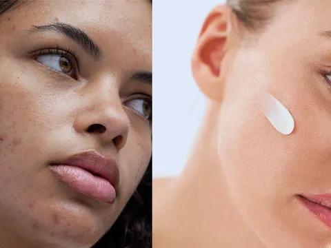 Da đỏ, bong tróc sau peel: Khi nào là bình thường?